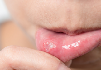 为什么不小心咬破嘴就口腔溃疡了 口腔溃疡怎么愈合快
