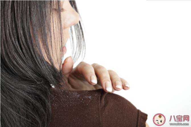 头皮屑太多剃成光头还有头皮屑吗 头皮屑太多怎么去除