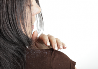 头皮屑太多剃成光头还有头皮屑吗 头皮屑太多怎么去除