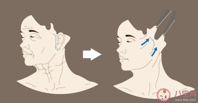 拉皮的最佳年龄是多少岁 拉皮手术后疤痕会很明显吗 拉皮的最佳年龄是多少岁 拉皮手术后疤痕会很明显吗