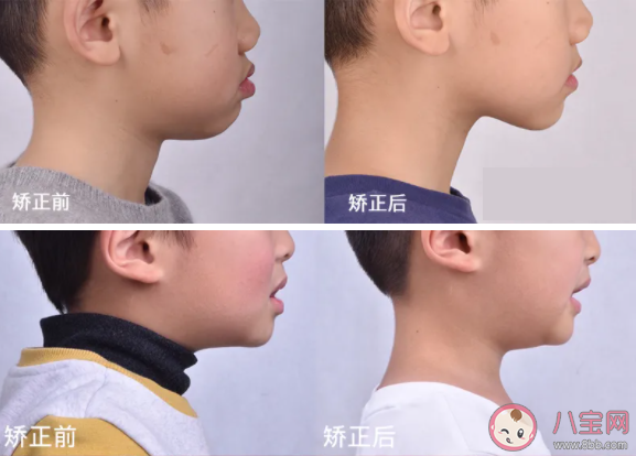 孩子有地包天可以长大后再矫正吗 孩子地包天怎么矫正治疗