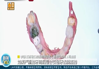 专家称老了未必掉牙 掉牙是什么原因导致的