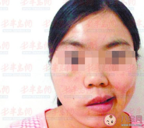 7岁小女孩洗头后骑车成面瘫 哪些行为会导致面瘫