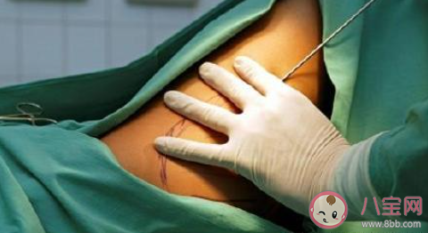 吸脂手术到底存在哪些危险 吸脂手术真的有用吗