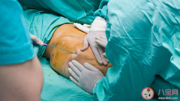 抽脂减肥还会胖回来吗 抽脂手术有哪些副作用风险