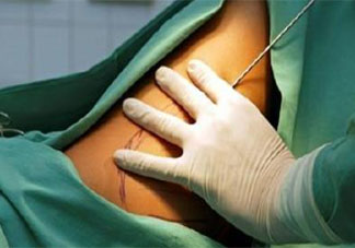 吸脂手术到底存在哪些危险 吸脂手术真的有用吗