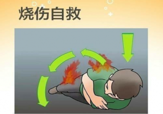 医生科普烧伤后如何自救 应对烧烫伤的五个规定动作