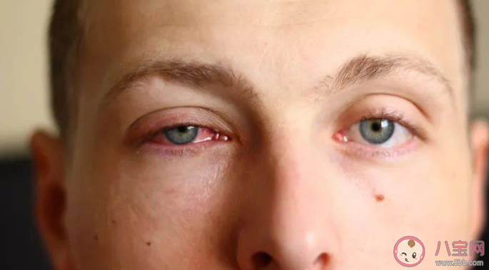 电光性眼炎有什么症状表现 得了电光性眼炎怎么办 电光性眼炎有什么症状表现 得了电光性眼炎怎么办