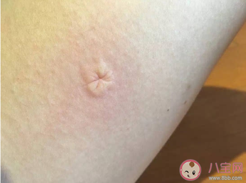 被蚊子咬了掐十字能止痒吗 涂口水可以止痒吗