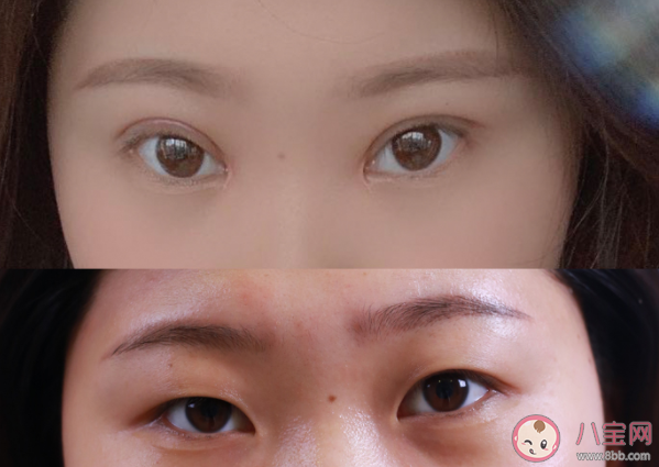 双眼皮手术会影响视力吗 双眼皮术后眼睛充血正常吗