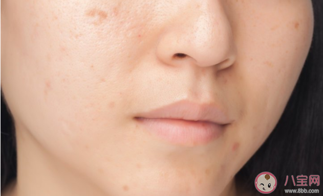 祛痣是去美容院还是医院 祛除黑痣最有效的方法是什么