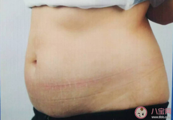 吸脂以后会不会导致皮肤松弛下垂 哪些部位可以吸脂 吸脂以后会不会导致皮肤松弛下垂 哪些部位可以吸脂