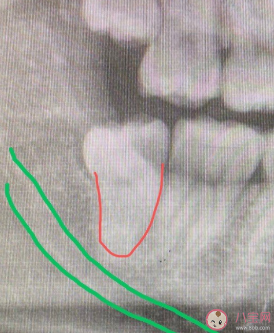 智齿能不能一次拔掉4颗 智齿没拔干净有事吗