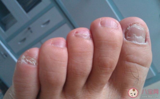 怎么判断自己是不是有灰指甲 有灰指甲会有什么危害