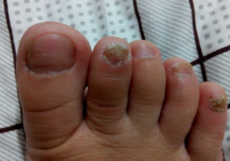 得了灰指甲一定要拔掉指甲才能好吗 怎样正确去掉灰指甲