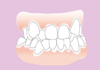 智齿能不能一次拔掉4颗 智齿没拔干净有事吗