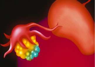 年纪轻轻为什么会得卵巢囊肿 卵巢囊肿有哪些并发症