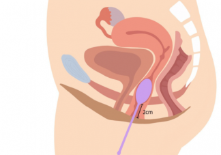 没生过孩子就不需要做盆底肌修复吗 孕期怎么做避免减轻盆底肌损伤