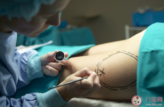 抽脂手术是不是减肥 什么情况不适合做抽脂手术 抽脂手术是不是减肥 什么情况不适合做抽脂手术