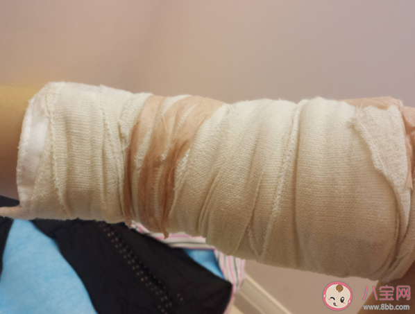 抽脂手术是不是减肥 什么情况不适合做抽脂手术 抽脂手术是不是减肥 什么情况不适合做抽脂手术