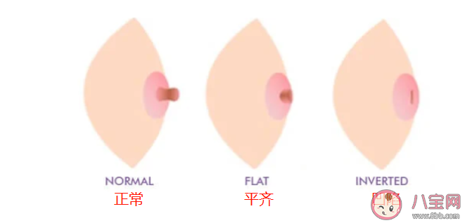 怎样的乳头算内陷 怎么判断乳头内陷的严重程度