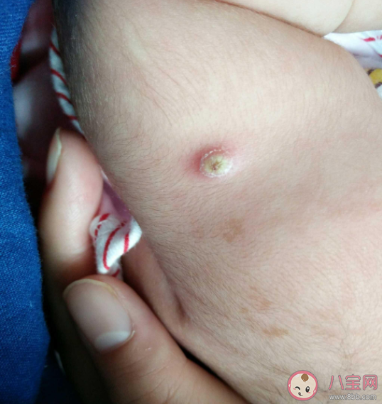 宝宝打预防针的地方化脓了严重吗 接种部位脓肿发生破溃时怎么办