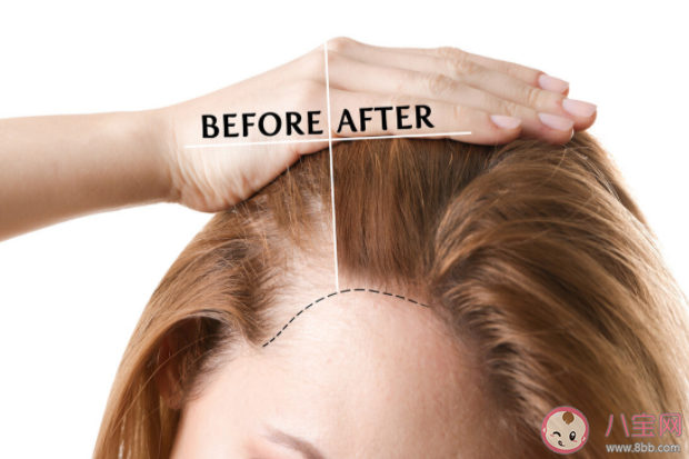 发际线后退可以自行恢复吗 怎么保护发际线不后移