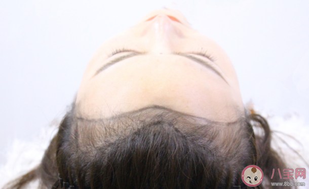 发际线后退可以自行恢复吗 怎么保护发际线不后移