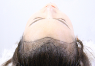 发际线后退可以自行恢复吗 怎么保护发际线不后移