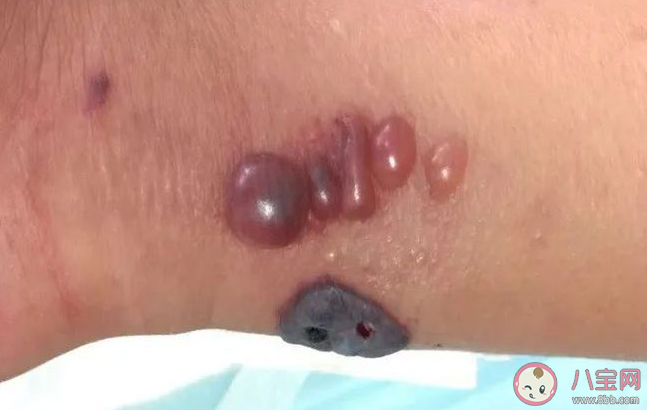 炭疽病有哪些危害 普通人怎样预防炭疽