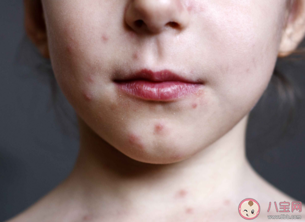 人为什么会长痘痘 长了痘痘一定要注意的8件事 人为什么会长痘痘 长了痘痘一定要注意的8件事