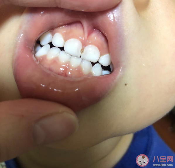 牙齿有黑缝可能是蛀牙了吗 黑缝是如何产生的
