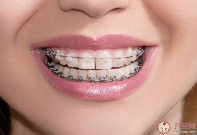 为什么牙齿矫正后会反弹 如何避免矫正后反弹