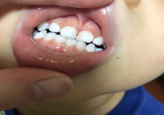 牙齿有黑缝可能是蛀牙了吗 黑缝是如何产生的