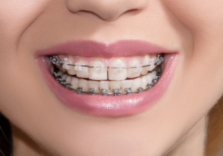 为什么牙齿矫正后会反弹 如何避免矫正后反弹