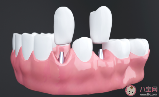 为什么种植牙那么贵 种植牙的优点好处是什么