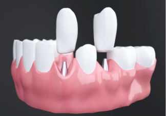 为什么种植牙那么贵 种植牙的优点好处是什么