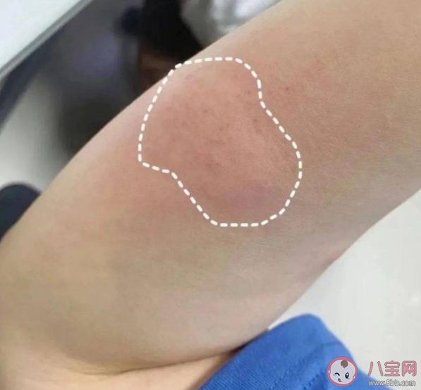 蚂蚁庄园蚊子叮的包越大说明毒性越强这种说法正确吗 8月25日正确答案