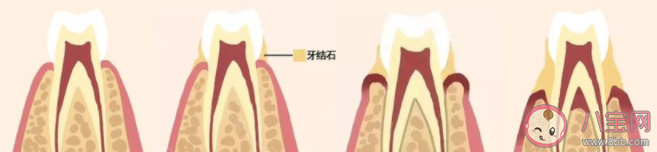 长期不刷牙会引发肺炎吗 刷牙最重要的是刷哪里