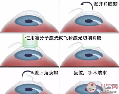 做近视眼手术是个好选择吗 近视眼手术能根治近视吗