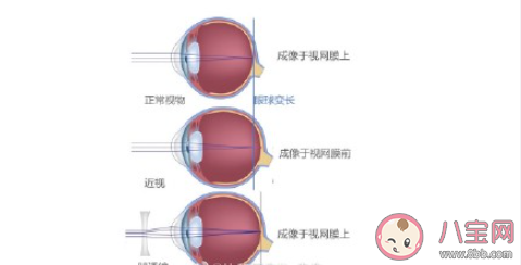 做近视眼手术是个好选择吗 近视眼手术能根治近视吗