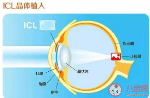 做近视眼手术是个好选择吗 近视眼手术能根治近视吗