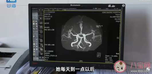 20岁女生长期熬夜诱发癫痫 长期熬夜会有哪些危害