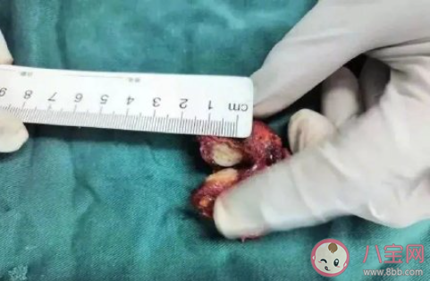 女子2年没复查甲状腺结节变成癌 甲状腺结节是什么病症