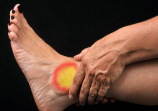 扭伤都可以用红花油吗 扭伤是该热敷还是冷敷