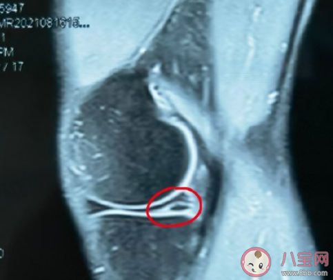 年纪轻轻膝盖怎么就不行了 如何保养好我们的膝盖