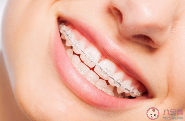 为什么戴牙套很久还是没变化 戴牙套需不需要忌口