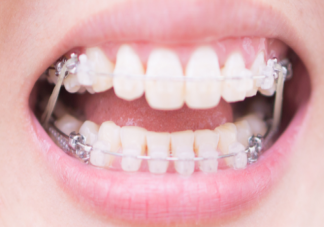 为什么戴牙套很久还是没变化 戴牙套需不需要忌口