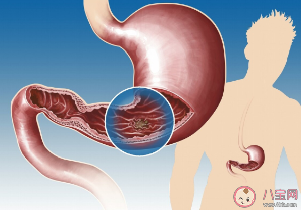经常性胃胀要忌口吗 经常胃胀气应该怎么办