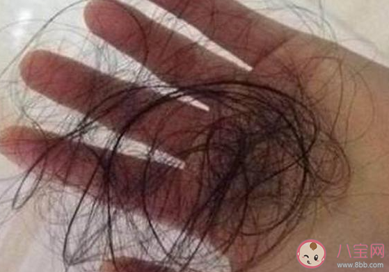 为什么年纪轻轻就脱发 怎样防止脱发 为什么年纪轻轻就脱发 怎样防止脱发